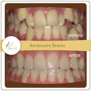 Braces before and after closing gaps &ndash; Arcadia orthodontist, teen patient, 柏宁牙科