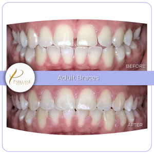 Braces before and after underbite and teeth gaps with our orthodontist in Arcadia