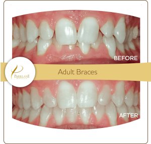 Braces before and after overbite correction &ndash; Temple City adult college student, with orthodontist in Arcadia