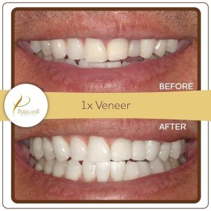 Before after single veneer for undersized tooth &ndash; アルカディアの歯医者