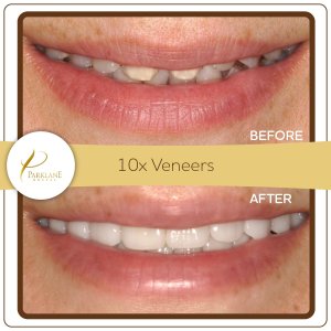 10 porcelain veneers for bride&rsquo;s confident smile &ndash; Arcadia cosmetic dentist