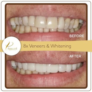 Before and after 8 veneers with crown redo &ndash; テンプルシティの歯科医