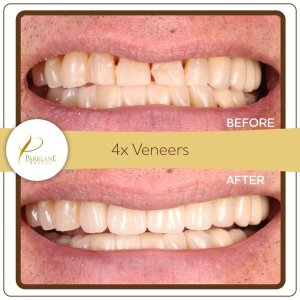 4 porcelain veneers to fix chipped front teeth &ndash; cosmetic dentist in Temple City