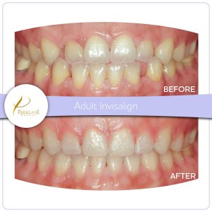 Before and after photo of a young girl's smile open spaces and underbite corrected with Invisalign with our orthodontist in Arcadia