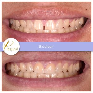 Bioclear before and after